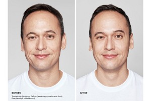 Restylane® Defyne