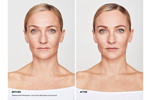 Restylane® Kysse