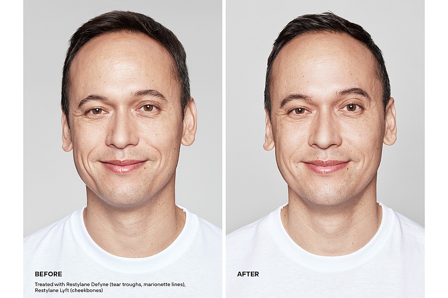 Restylane® Defyne